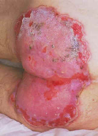 herpes genitalis #11