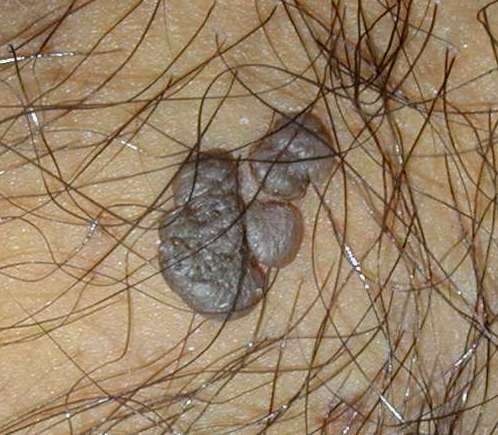 Warts Pictures | Photos & Images - What Do Warts Look Like?