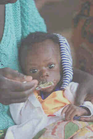malnourished baby